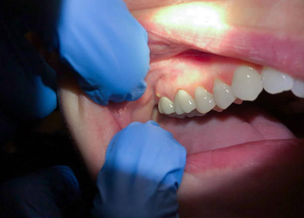 Best Emergency Dentist for Lost Fillings or Crowns in Dunean, SC